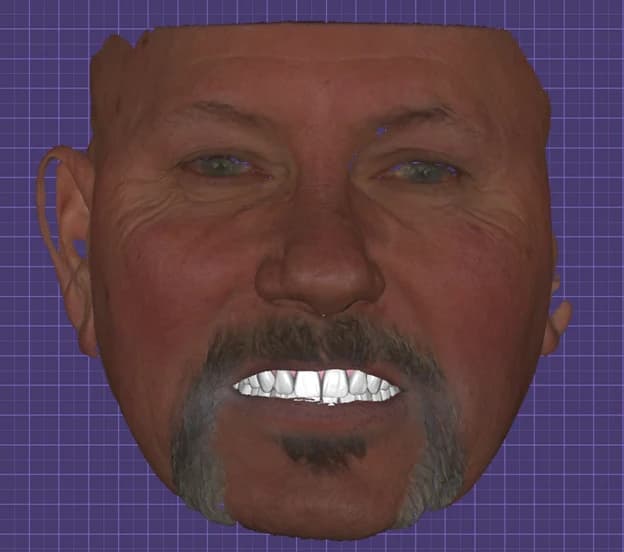 Three-dimensional facial scan displayed in implant-planning software