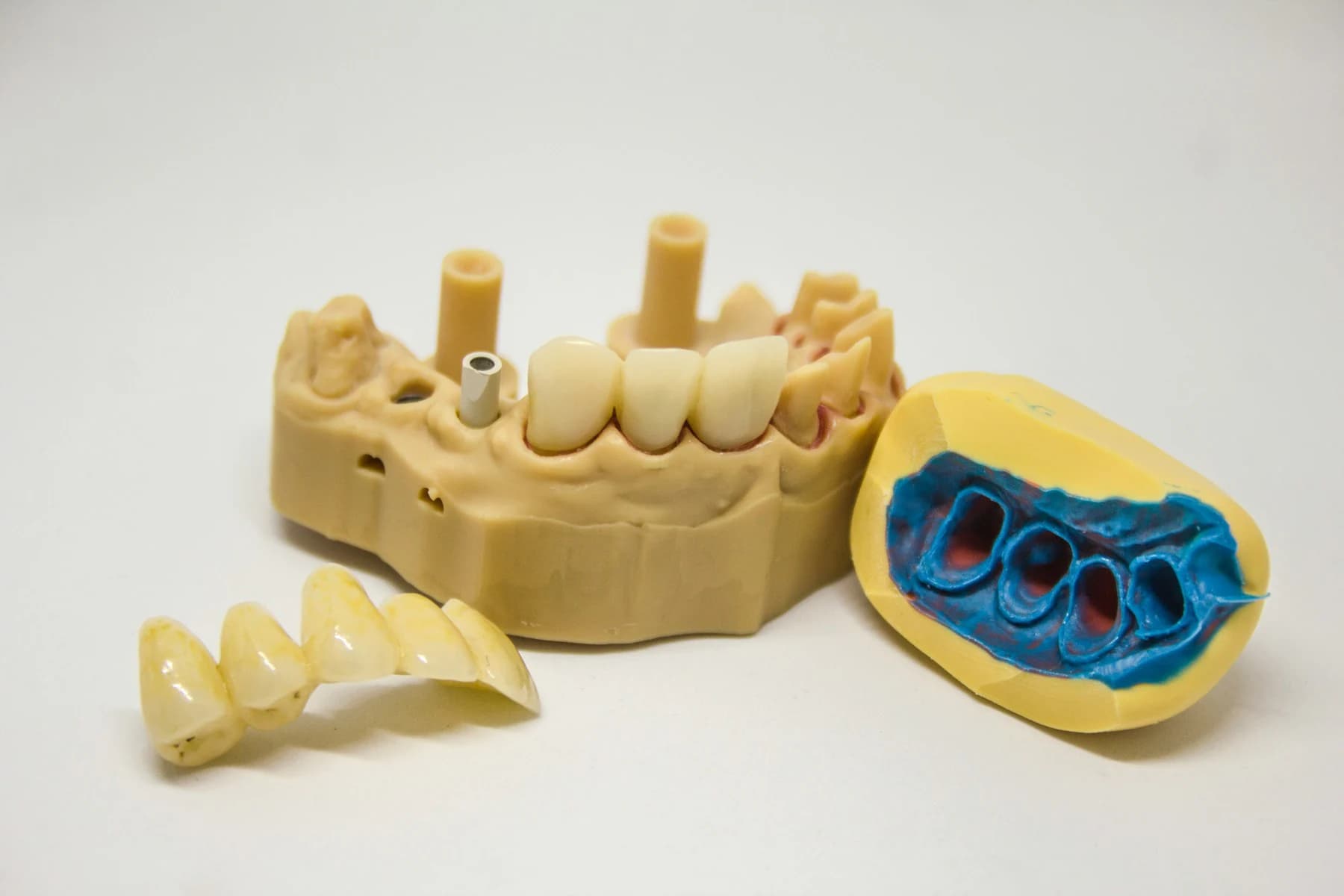 A working model with implant analogs beside a finished bridge and its impression