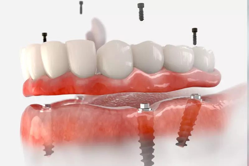 Full-arch dental implant model
