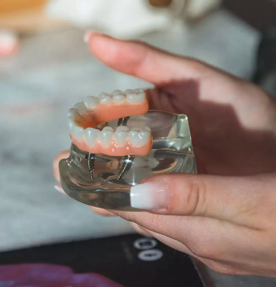 Implant bridge restoration prepared in the in-house lab