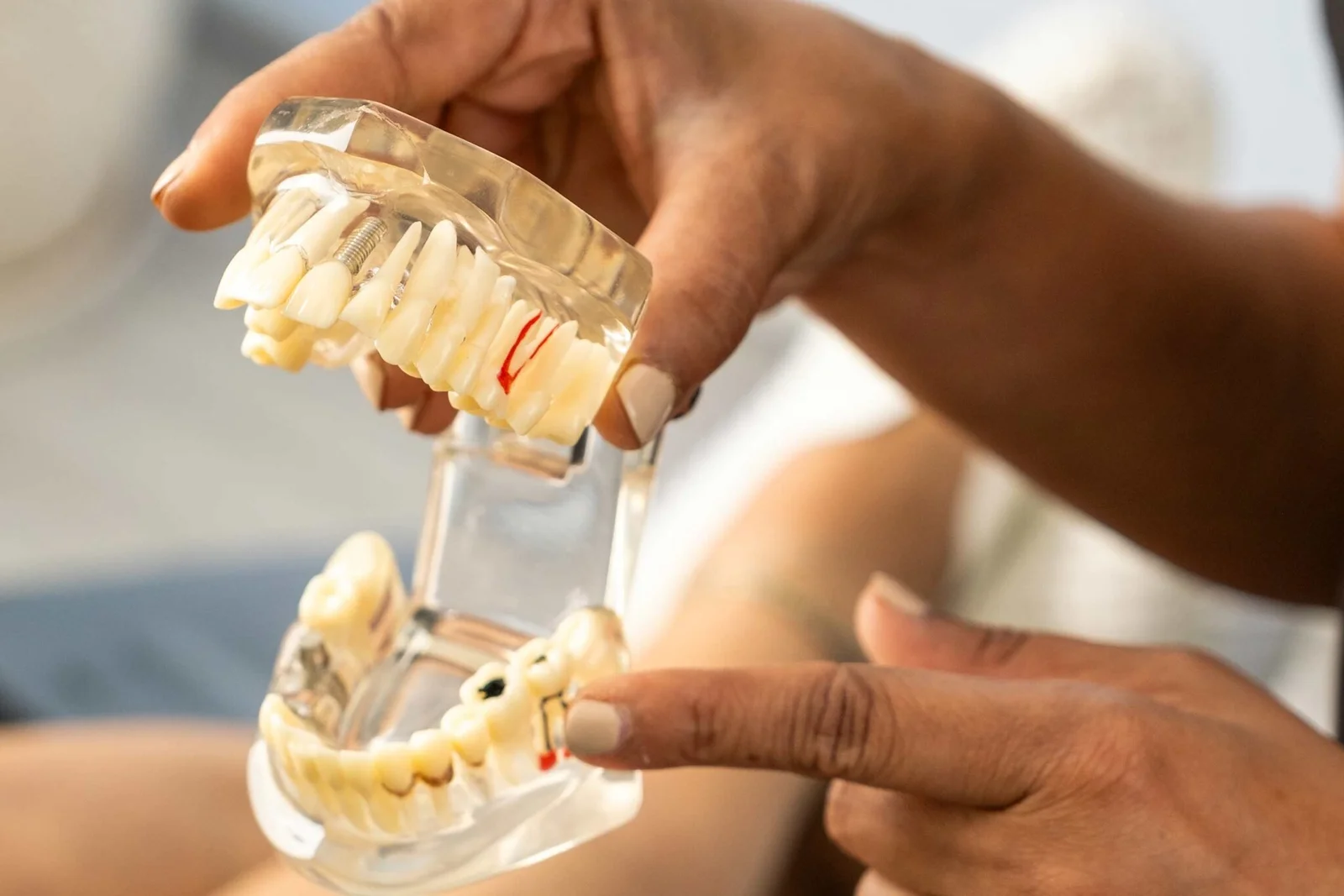 Model demonstrating an implant-supported bridge