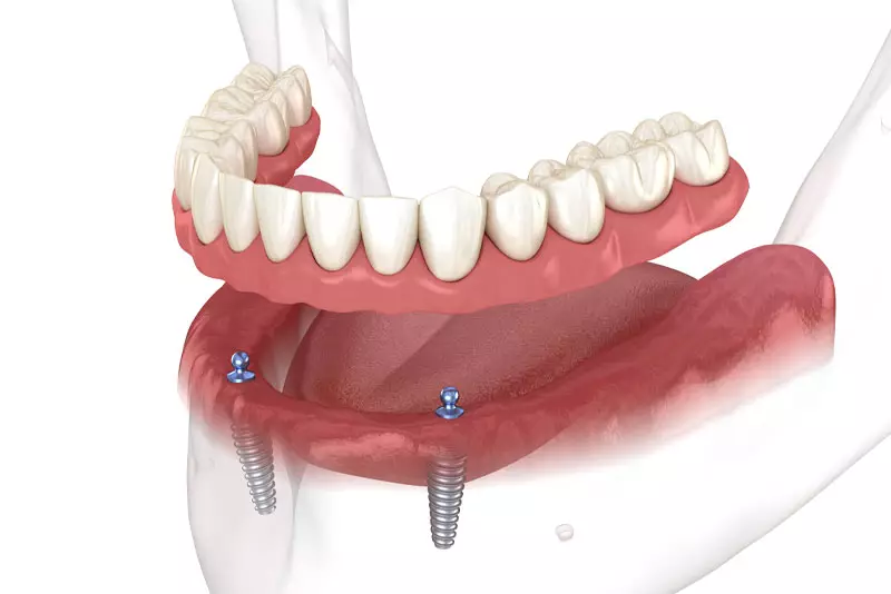 Implant-supported denture model