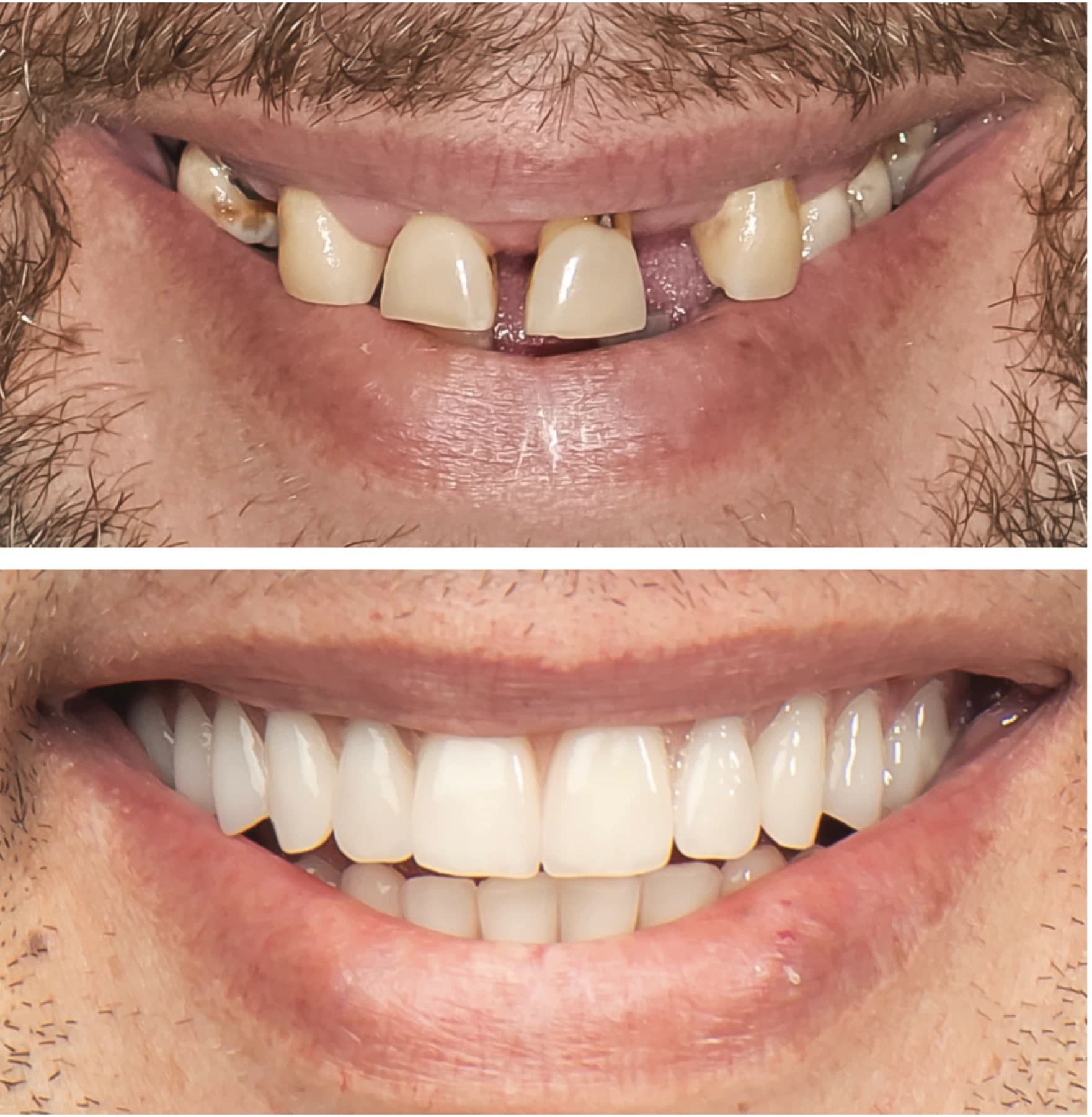 Before-and-after views of a full-arch implant restoration