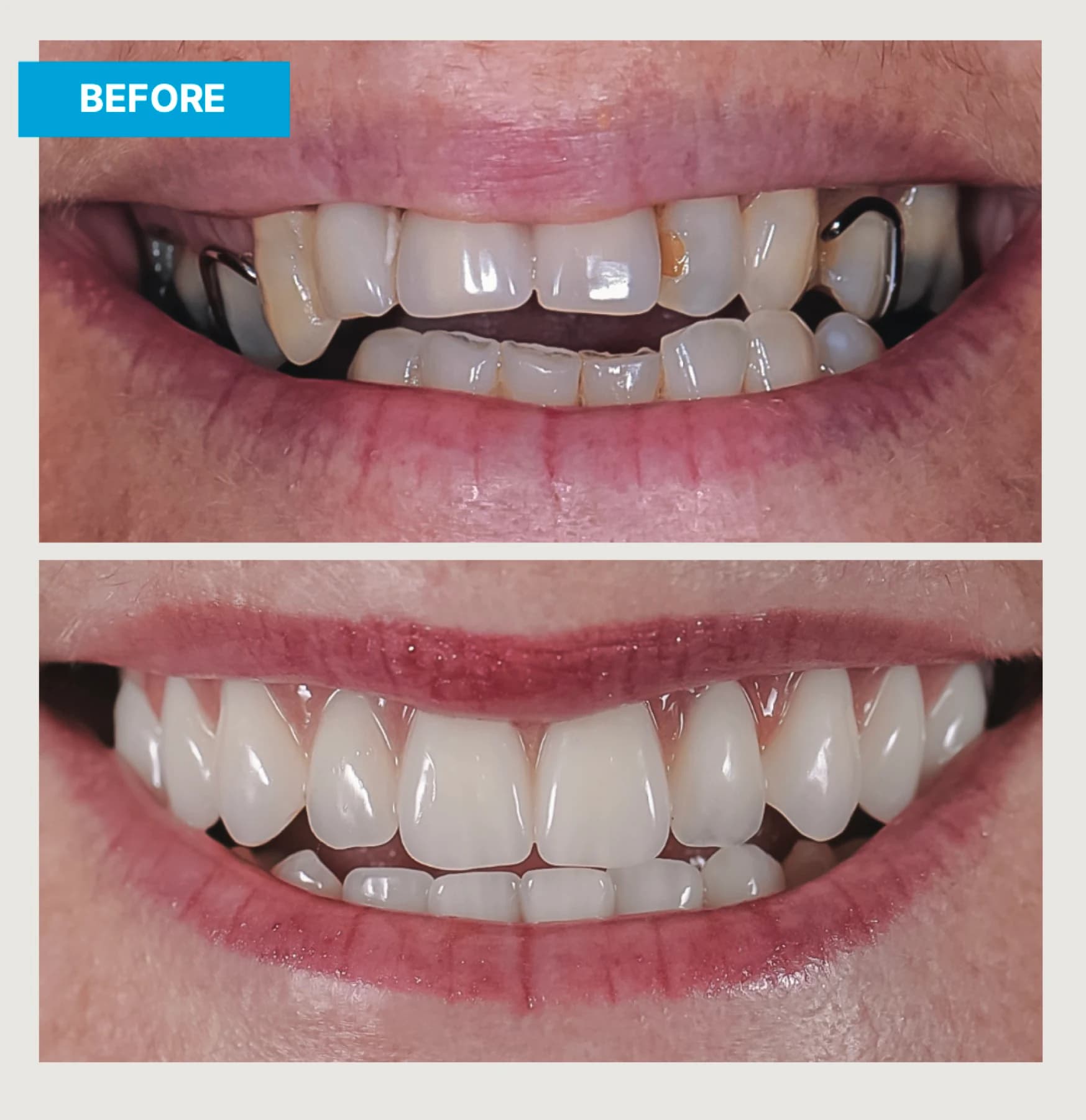 Before-and-after views of a full-mouth implant restoration