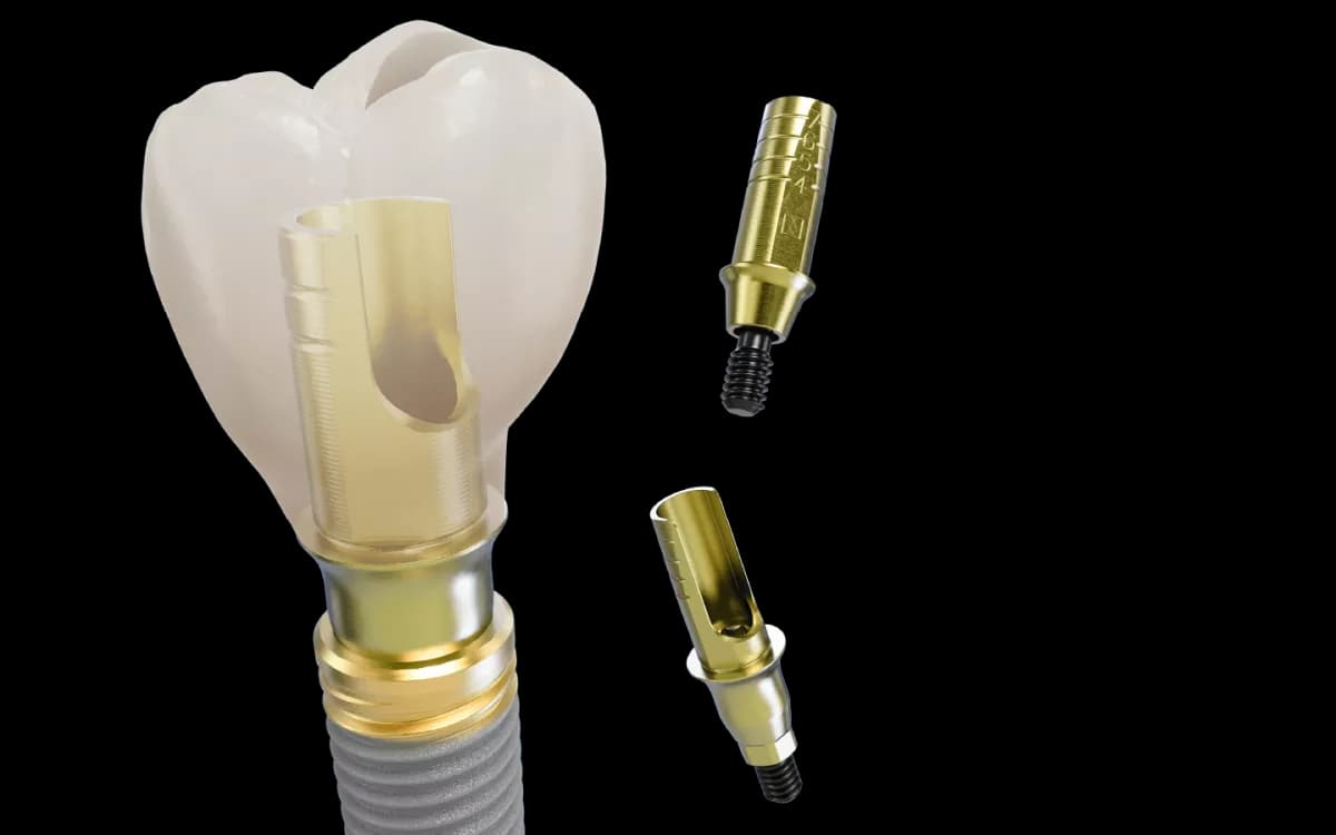 A dental implant, abutment and crown shown as the three separate parts they are