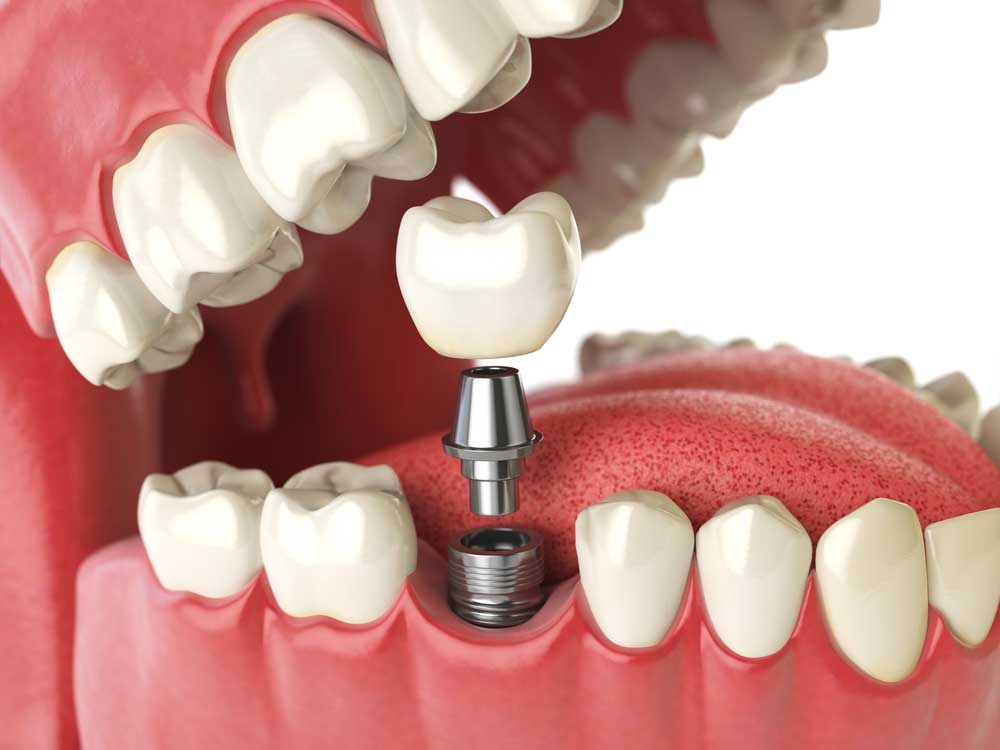 Dental implant san francisco