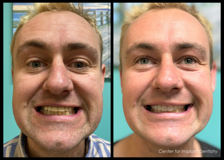 full-face-before-and-after