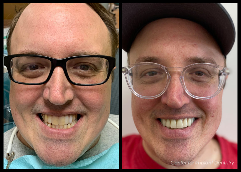 full-face-before-and-after35