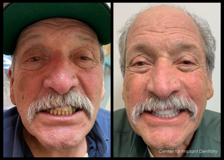 full-face-before-and-after6