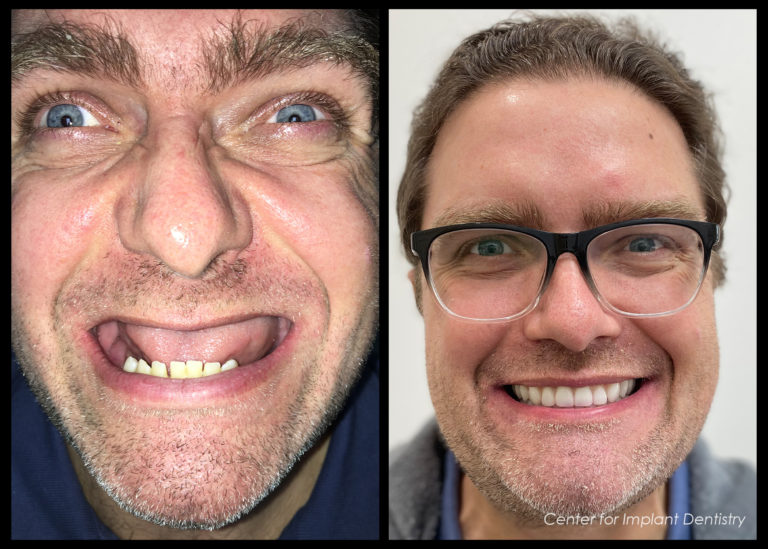 full-face-before-and-after17