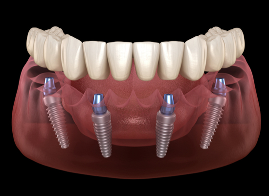 All-on-4 Implant