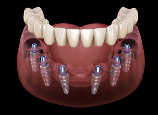 All-on-6 Implant