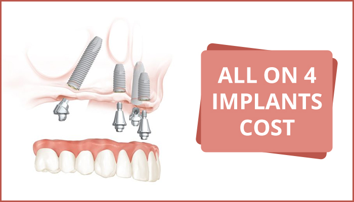 cheap all on 4 dental implants