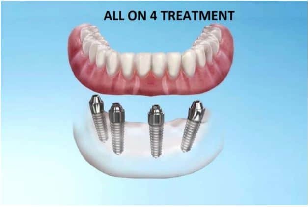 all on 4 dental implant