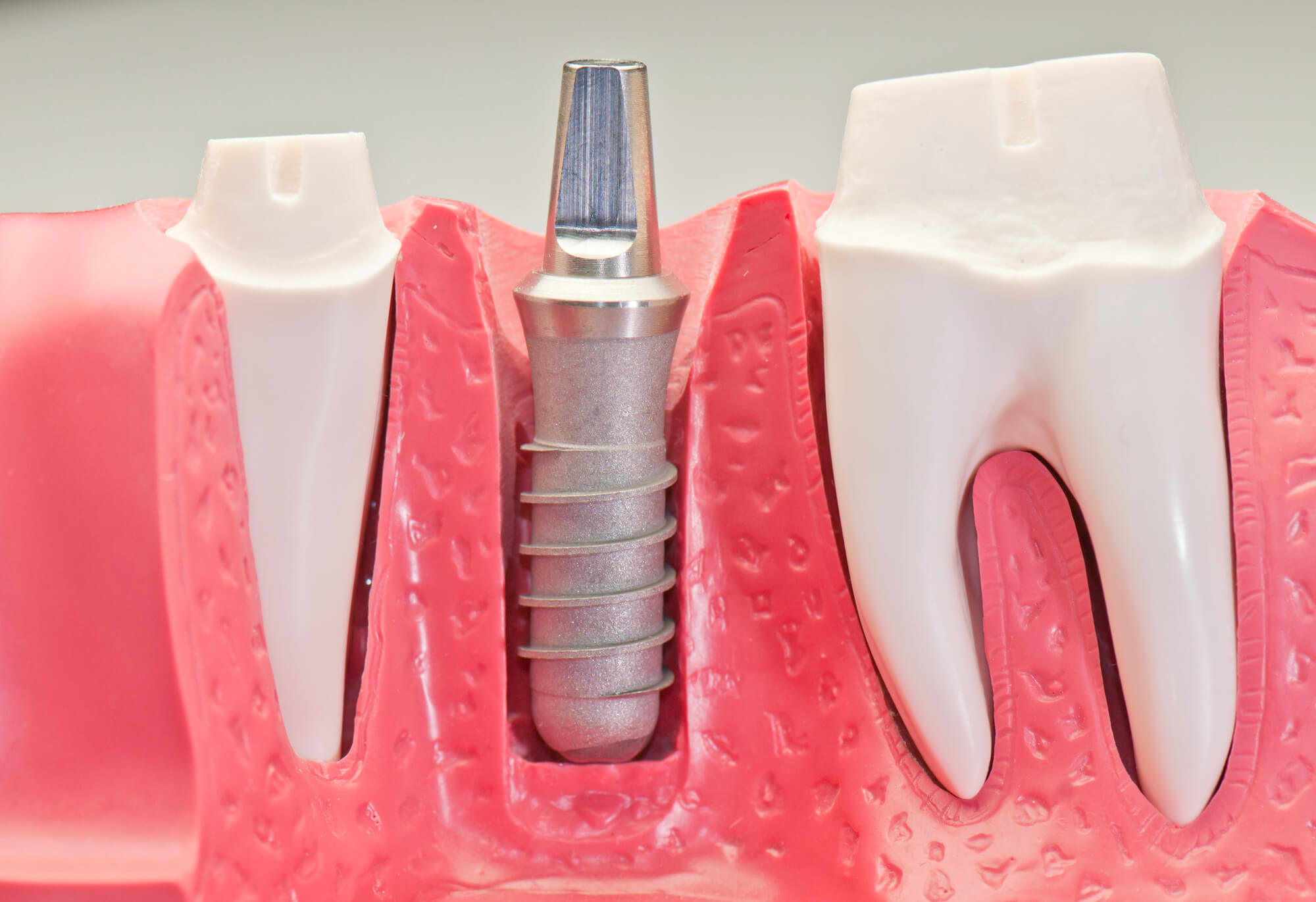 Dental Implants San Jose 
