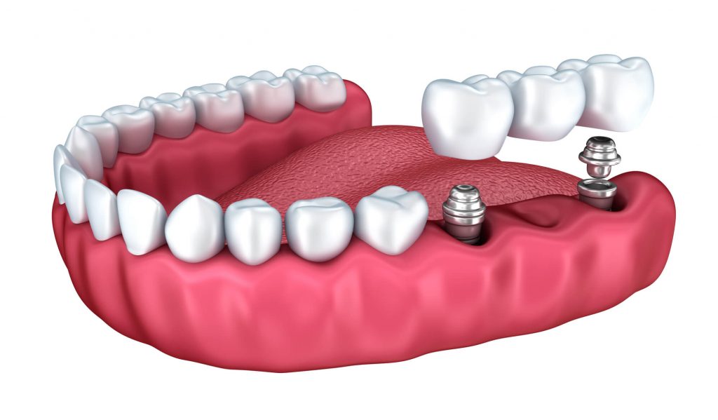 3D illustration from center for dental implants