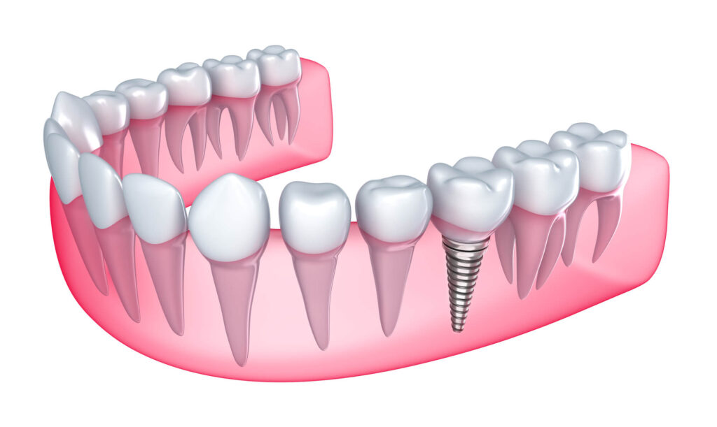 Illustration of a Dental implant in San Francisco placed on one of the lower teeth 