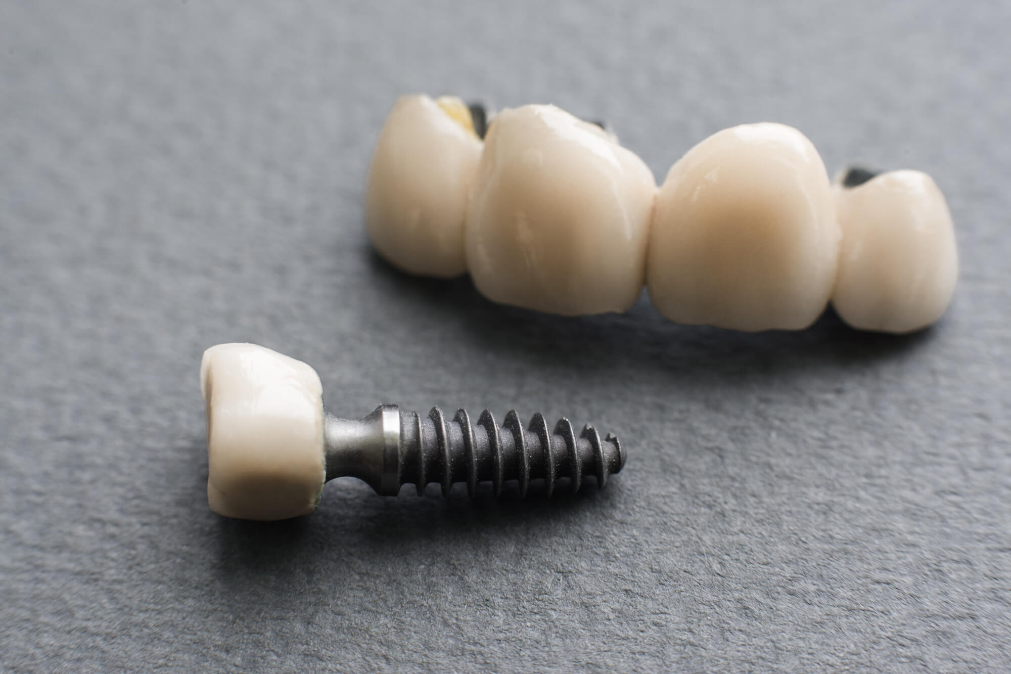single implant separated from the rest of SF dental implants