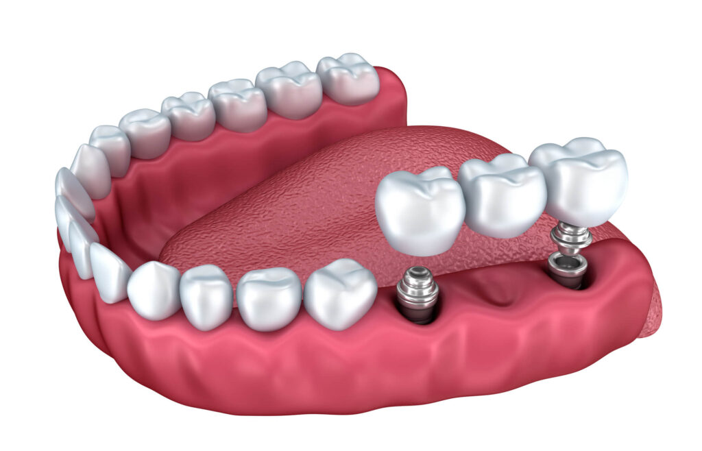 SF dental implants 3D illustration
