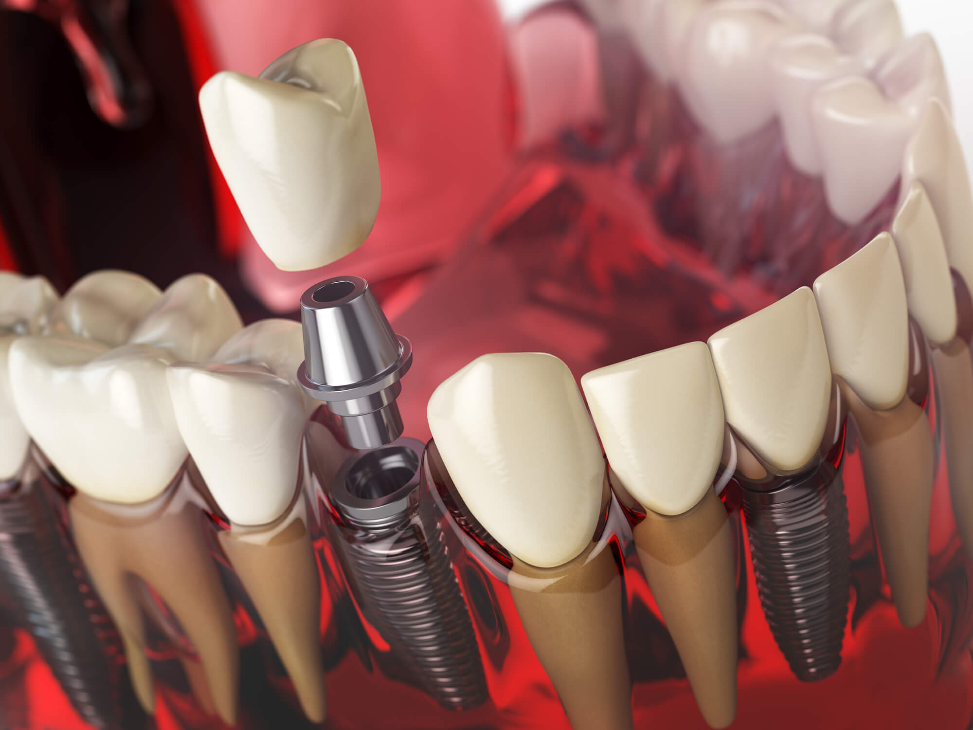 work of an Implant Dentist in San Francisco