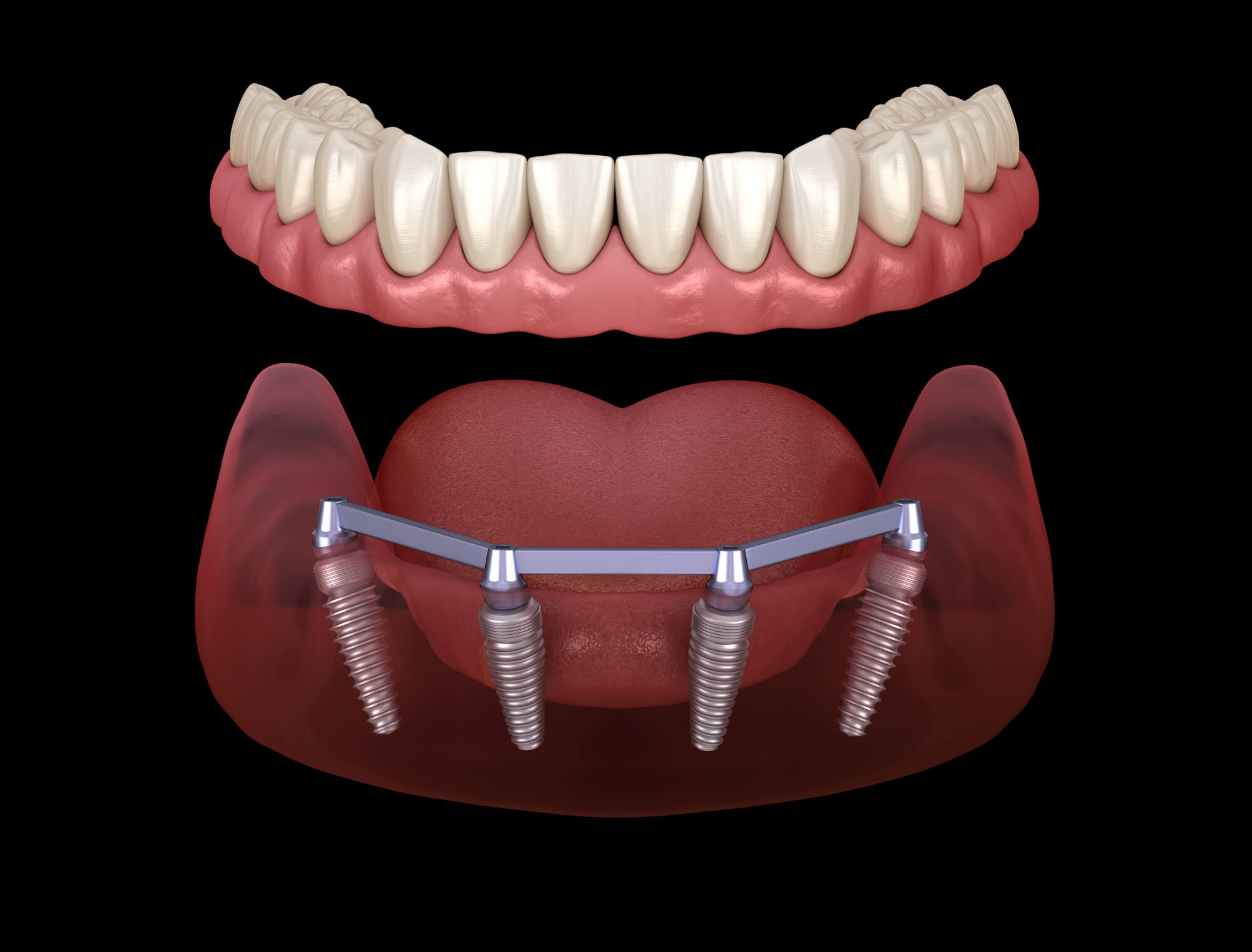 3D view of Cheap All on 4 Dental Implants