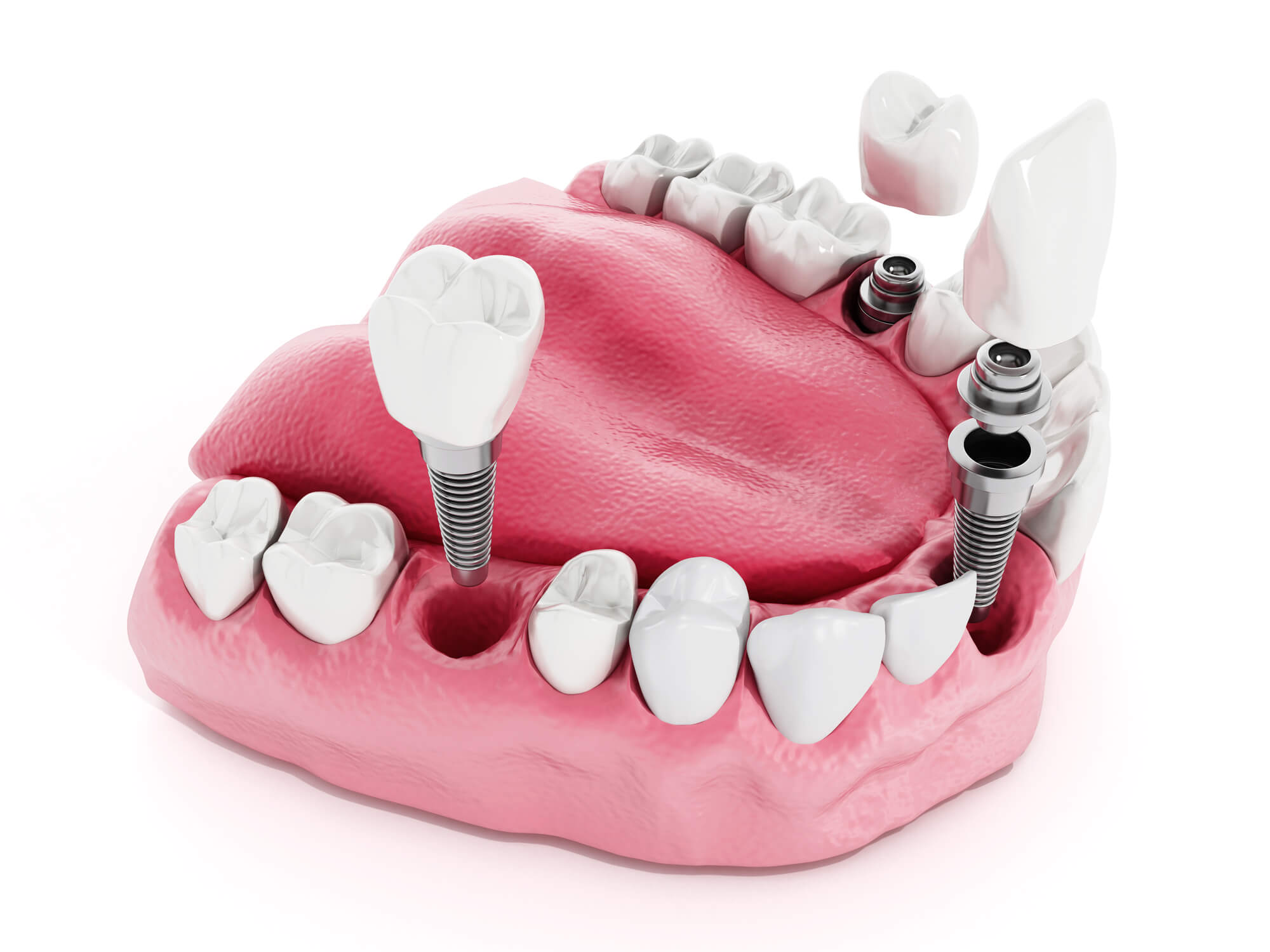 multiple missing teeth affecting the Cost for Dental Implants