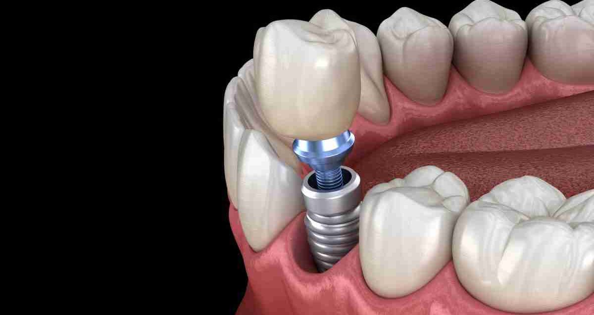 Who is Eligible for Same-Day Dental Implants?
