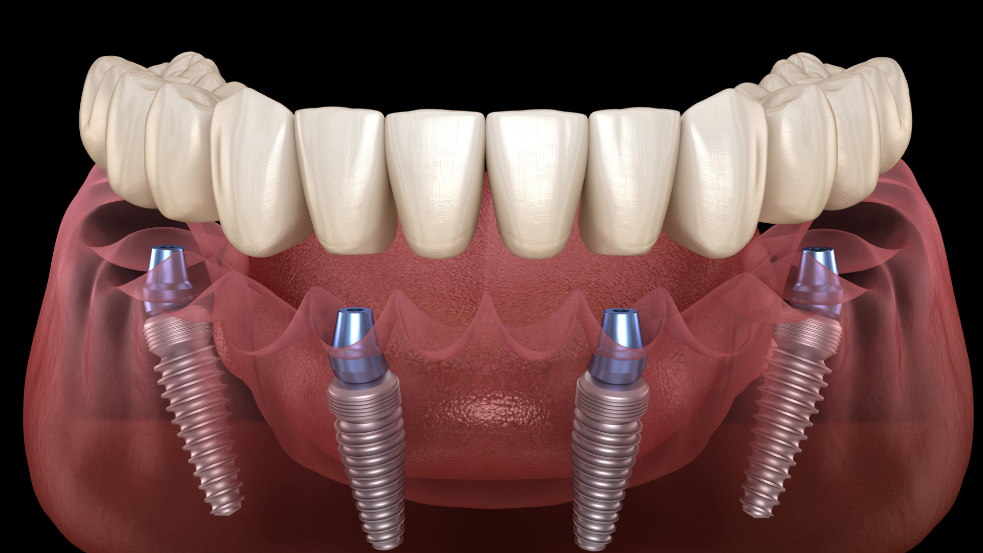 What Sets All on 4 Dental Implants Apart?
